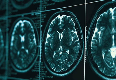 STADA startet Informationskampagne am Welt-Parkinson-Tag